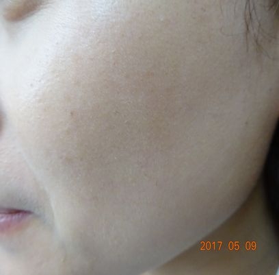 しみ・そばかす治療14日後の写真